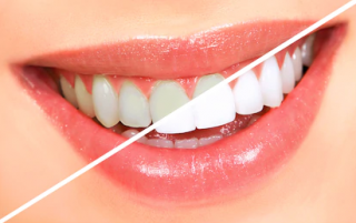 Professional Teeth Whitening at Sandgate bayside dental