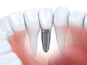 Dental Implants at Sandgate Dentist near Redcliffe
