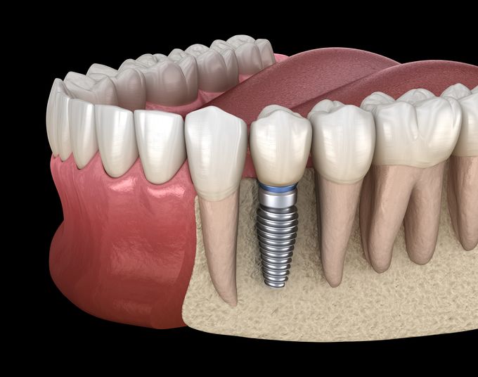 Dental Implants in Jaw