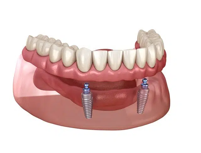 Mandibular removable prosthesis All on 2 system supported by imp