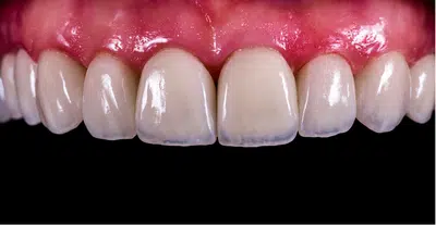 After Crown Cosmetic Dentistry