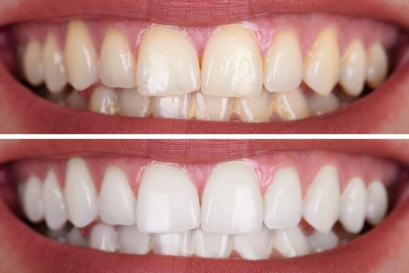 teeth-whitening-sandgate-bayside-dental.jpg