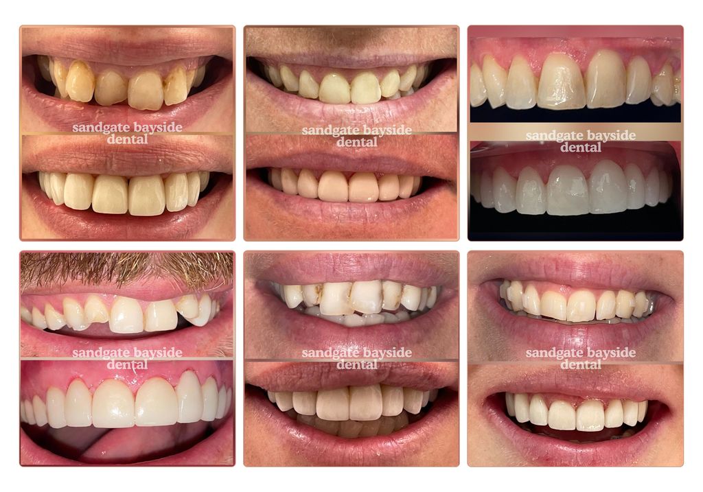 Collage showing before and after results of porcelain veneers on actual Sandgate Bayside Dental patients