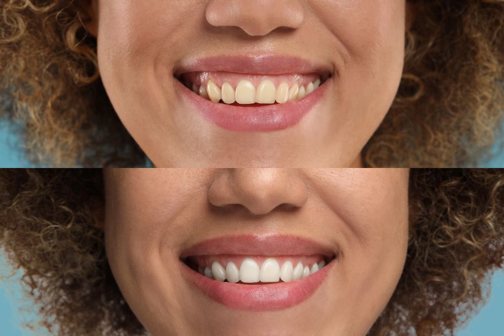 teeth-whitening-before-and-after.jpg