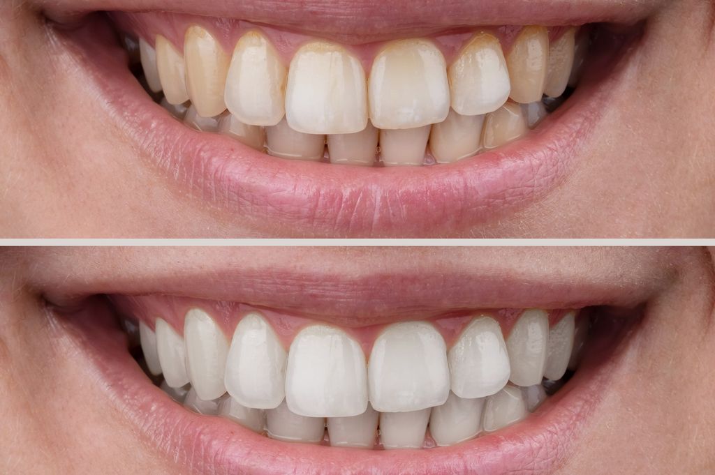 Close-up,Of,A,Woman's,Smile,Before,And,After,Teeth,Whitening.