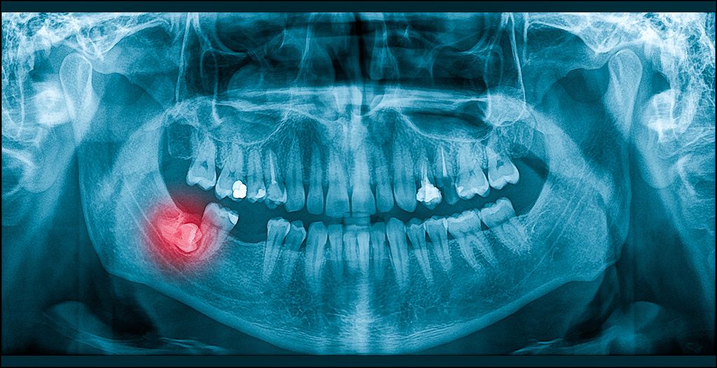 wisdom-teeth-xray.jpg