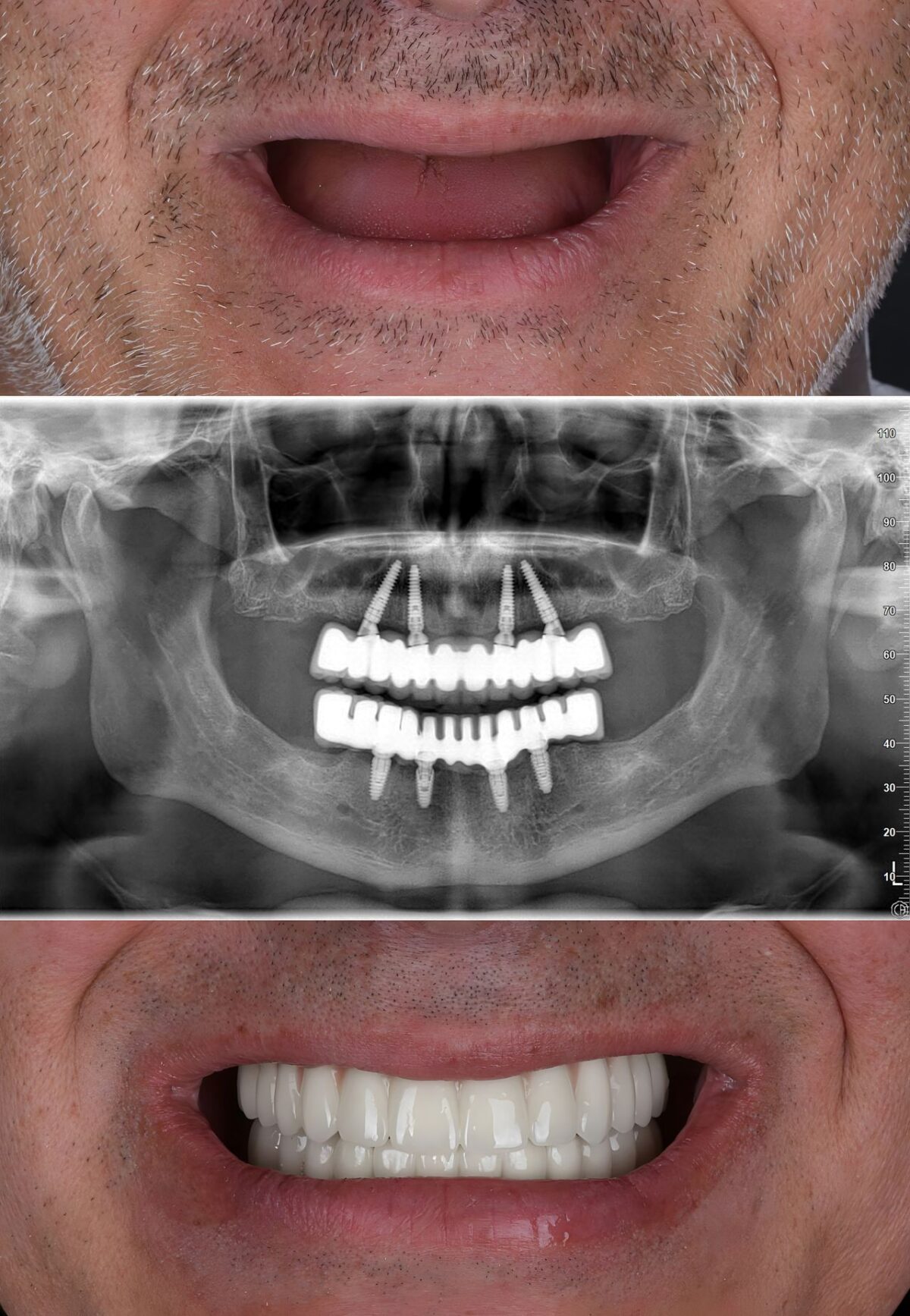 Full Mouth Dental Implants Full Mouth Dental Implants